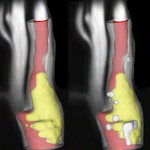 Image Analysis Technology Helps Prevent Strokes