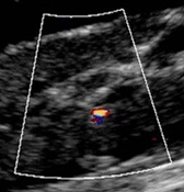 UW Researchers Develop Ultrasound Technology That Detects and Treats Kidney Stones in Space