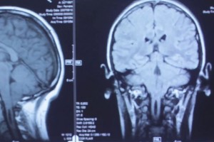 Short Film about UW technology “tumor paint” competing in Sundance Festival