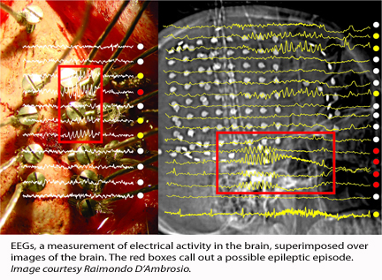UW Researchers Demonstrate Mild Brain Cooling After Head Injury Prevents Epileptic Seizures in Lab Study